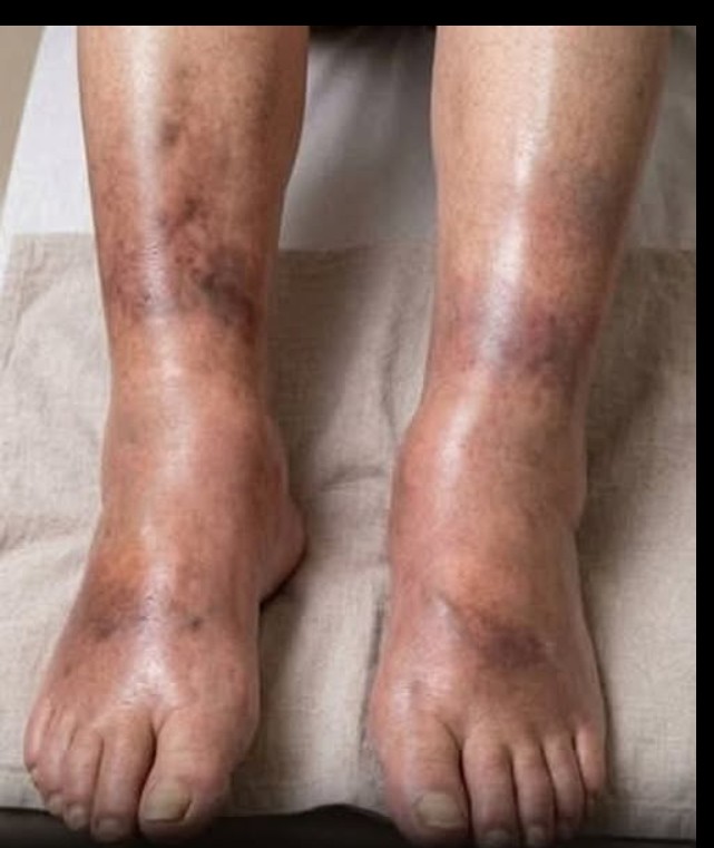 Oticanje nogu može imati različite uzroke: šta medicinska istraživanja govore o mogućoj vezi sa zdravljem pankreasa