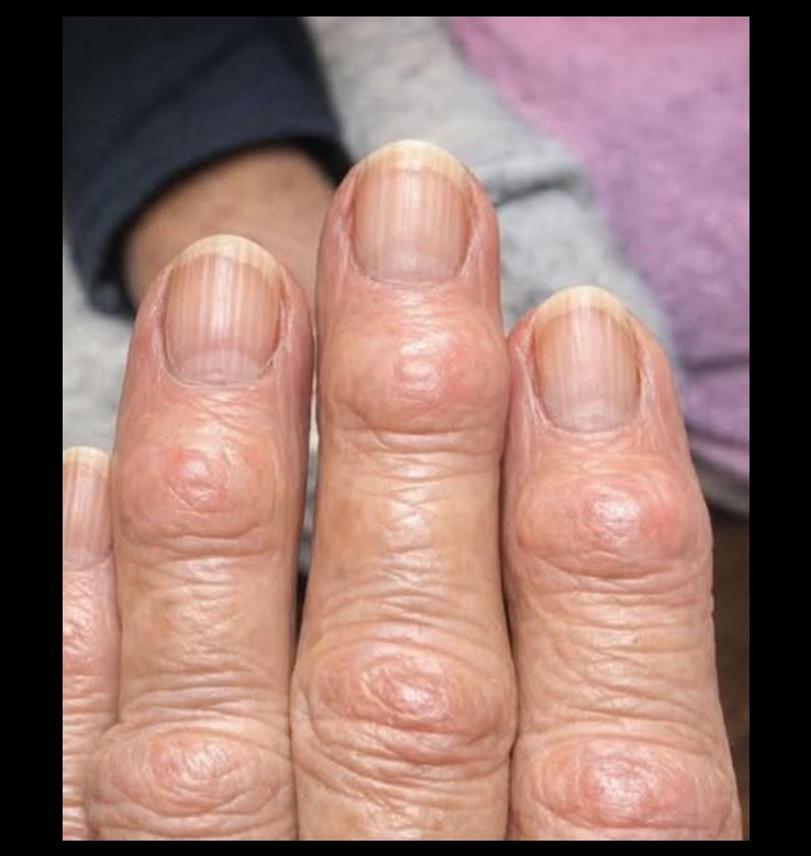 Kvržice na prstima: šta su Heberdenovi nodusi i kada treba obratiti pažnju