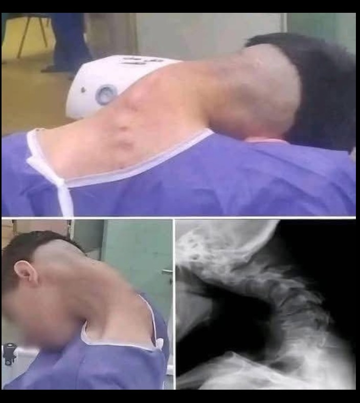 Rijetko stanje vrata kod mladića otvorilo pitanja o posljedicama dugotrajne ovisnosti