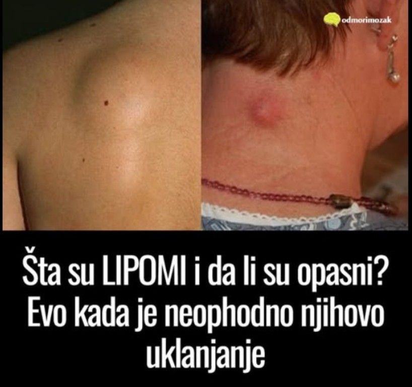 Šta su lipomi i da li su opasni kada je potrebno njihovo uklanjanje