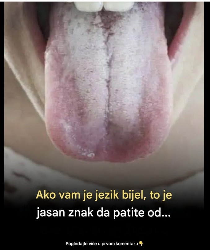 Šta znači kada vam jezik poprimi belu boju: Uzroci koje ne bi trebalo da ignorišete i kada je vreme za lekara
