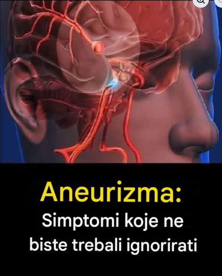 Mitovi i stvarnost o aneurizmi: Znakovi koje nikada ne smete ignorisati i šta nauka kaže o skrivenoj opasnosti