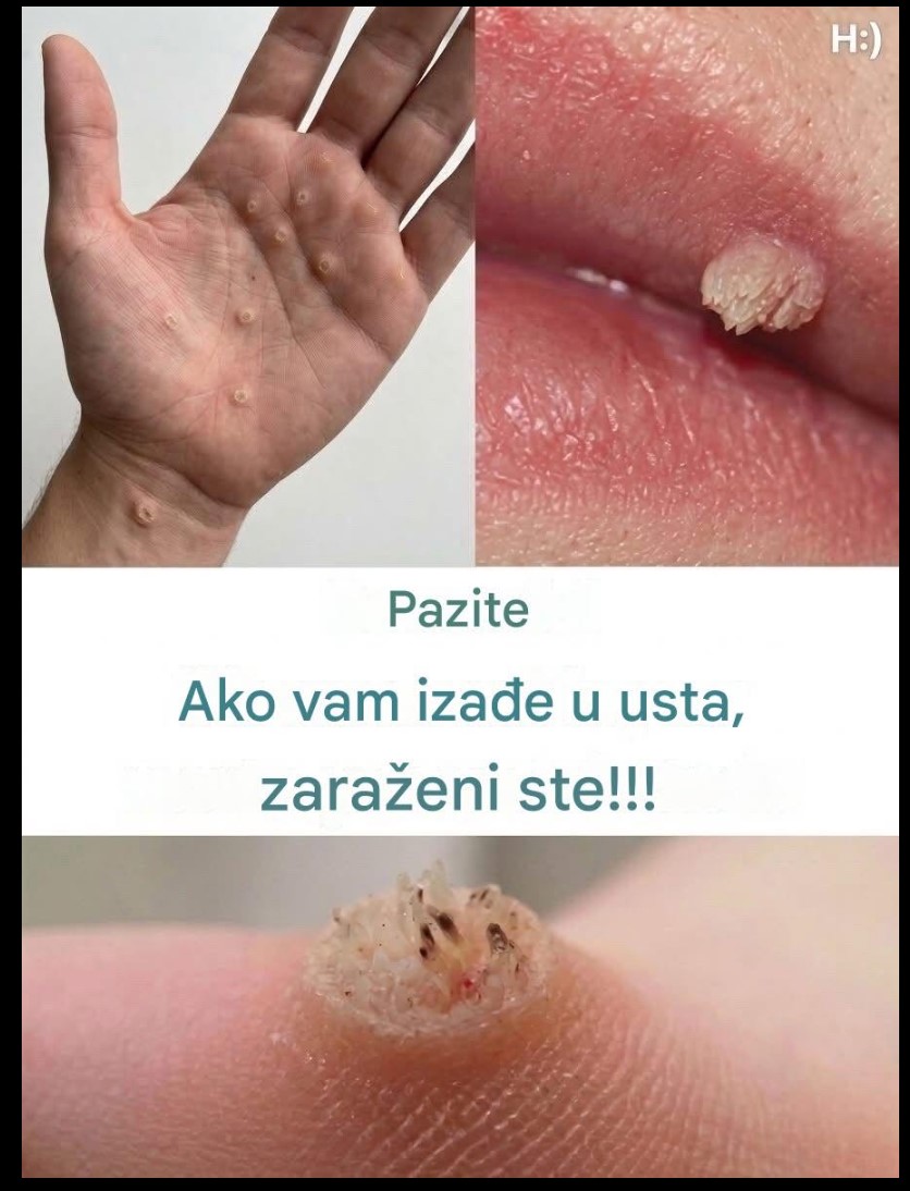 ŠTA ZNAČE OVE IZRASLINE NA KOŽI? Fotografija izazvala paniku na mrežama, stručnjaci upozoravaju da nije za ignorisanje