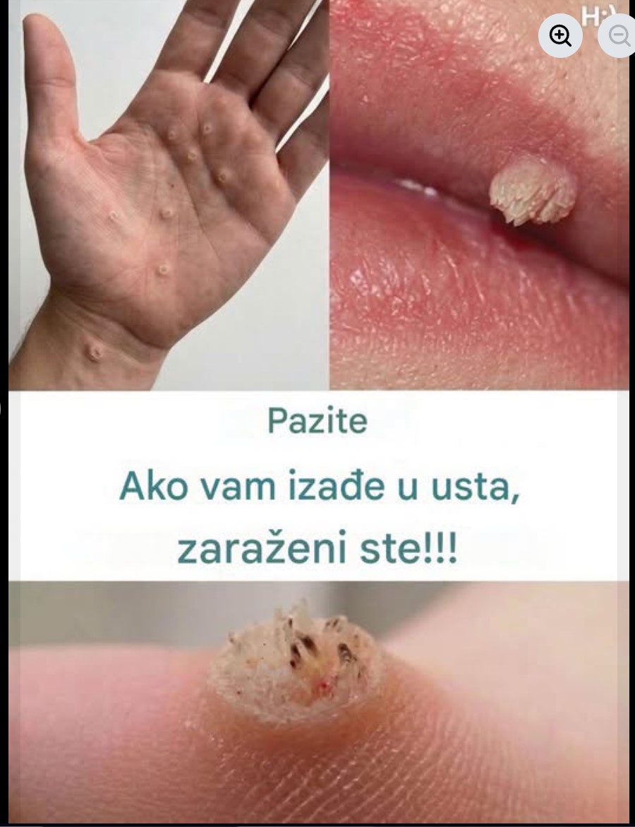 Viralna fotografija uznemirila internet: Da li su ove izrasline znak ozbiljne infekcije?