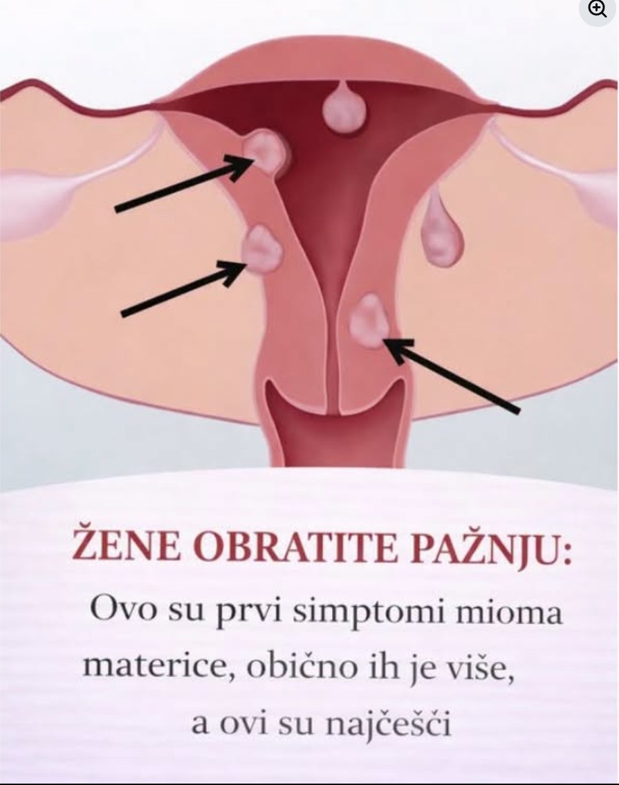 Zdravlje na prvom mestu: Simptomi mioma materice koje svaka žena treba da prepozna
