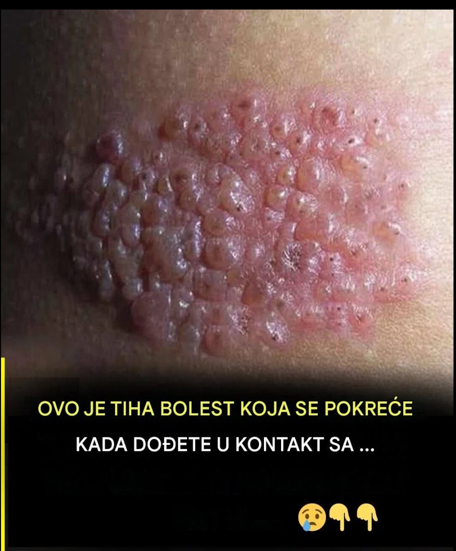 Tiha bolest koja se pojavljuje bez upozorenja: Šta sve morate znati o herpes zosteru