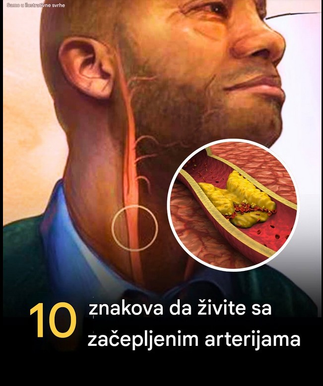 10 znakova koji ukazuju na to da su vam arterije začepljene