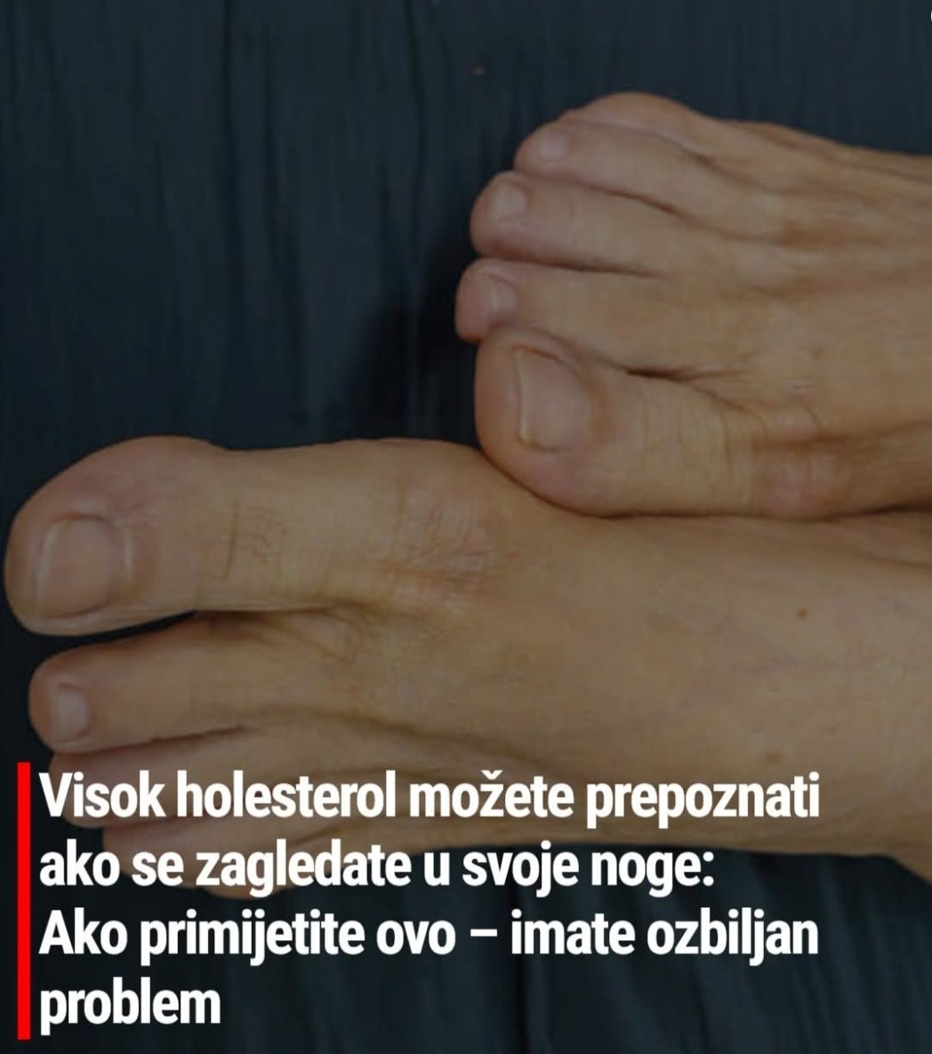 Visok holesterol možete prepoznati ako se zagledate u svoje noge: Ako primetite ove simptome – imate ozbiljan problem