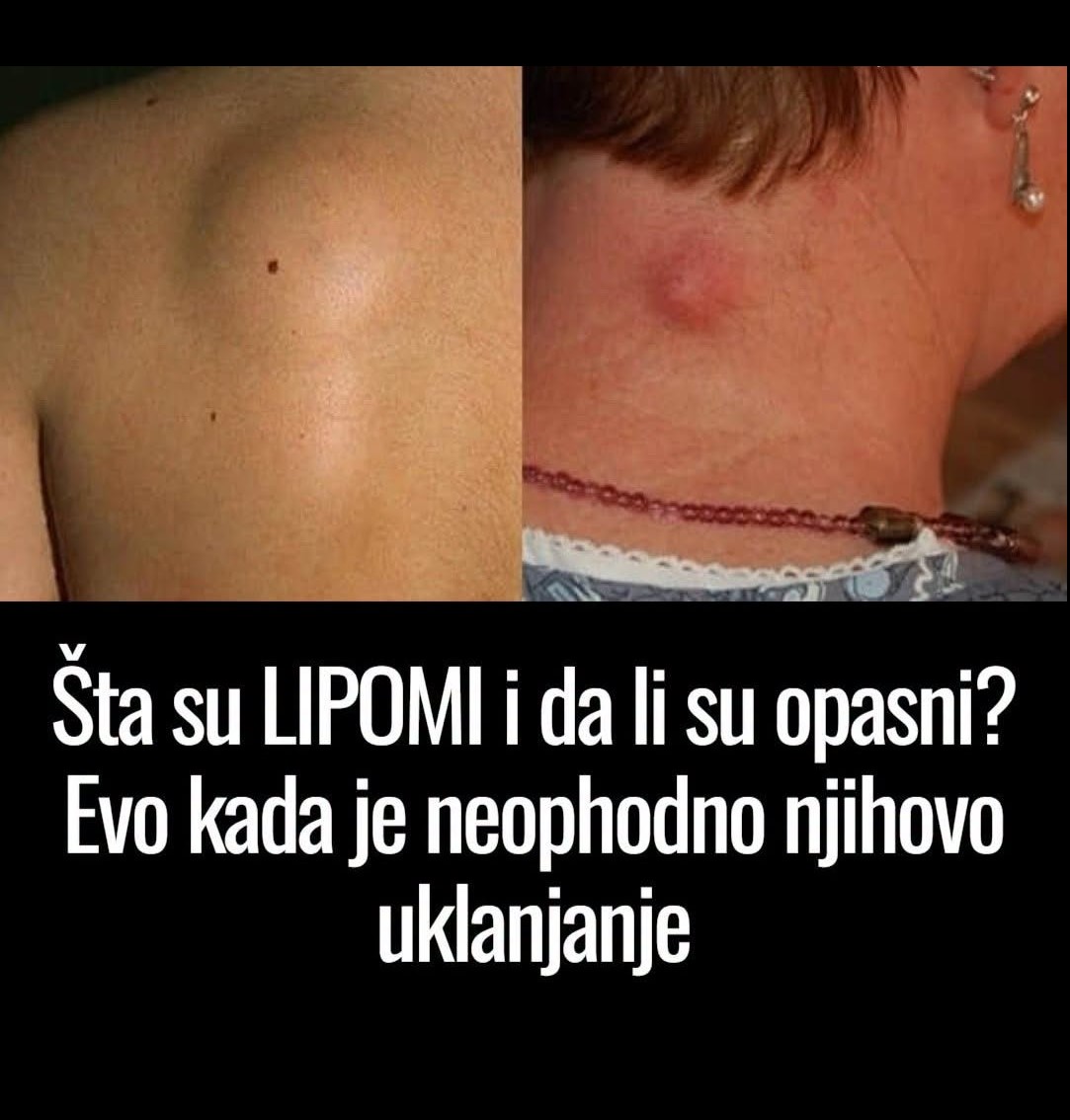 Šta su LIPOMI i da li su opasni? Evo kada je neophodno njihovo uklanjanje