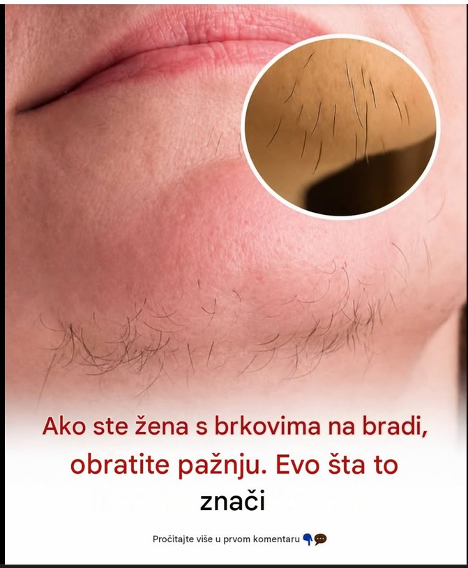 Znate li zašto se kod žena javljaju dlačice na bradi? Evo šta vam organizam poručuje