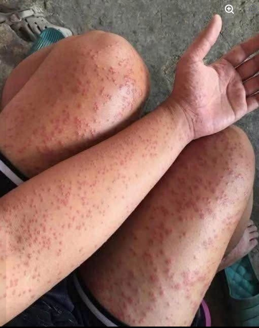 SIMPTOMI ALERGIJSKE REAKCIJE KOJE NE SMETE IGNORISATI: Anafilaksija može napredovati za svega nekoliko minuta