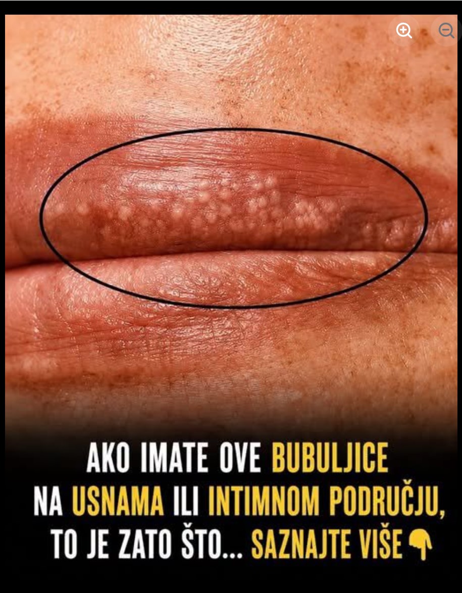 Bele tačkice i izbočine na usnama i intimnoj regiji: Kada su bezazlene, a kada treba otići lekaru?