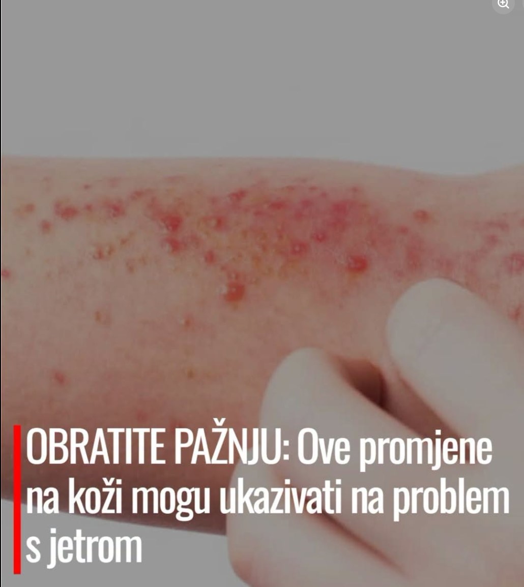 OBRATITE PAŽNJU: Promene na koži koje mogu ukazivati na ozbiljne probleme sa jetrom