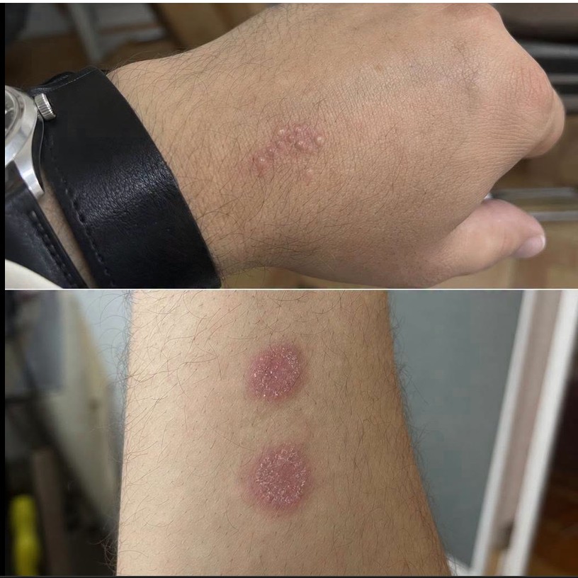 Kružne crvene promene na koži mogu ukazivati na infekciju, ali ne otkrivaju prevaru partnera