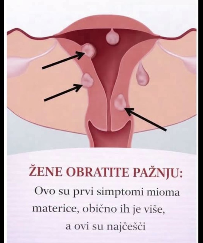 Miomi materice: Važni simptomi koje žene ne bi trebalo da ignorišu